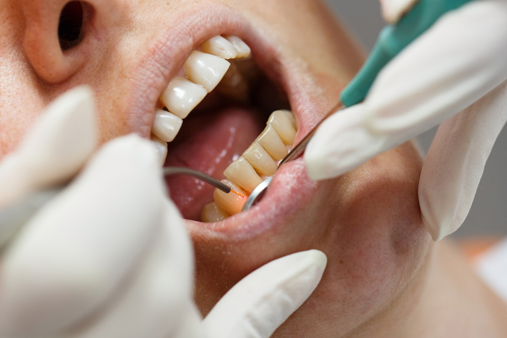 Laser Treatment For Teeth