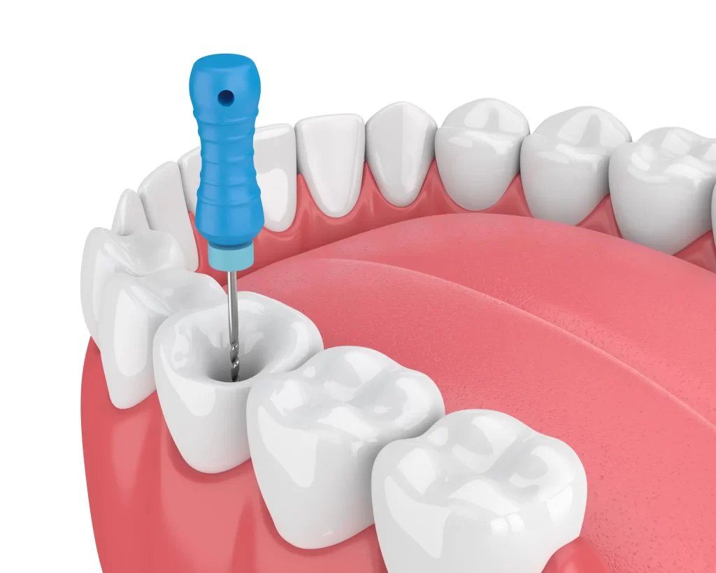 Root Canal Treatment