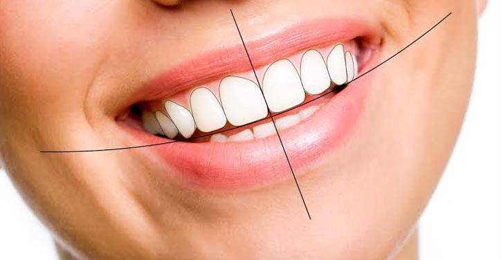 Smile Designing