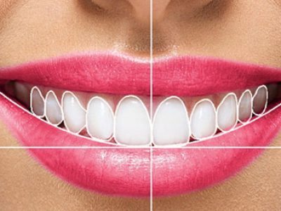 Smile Designing